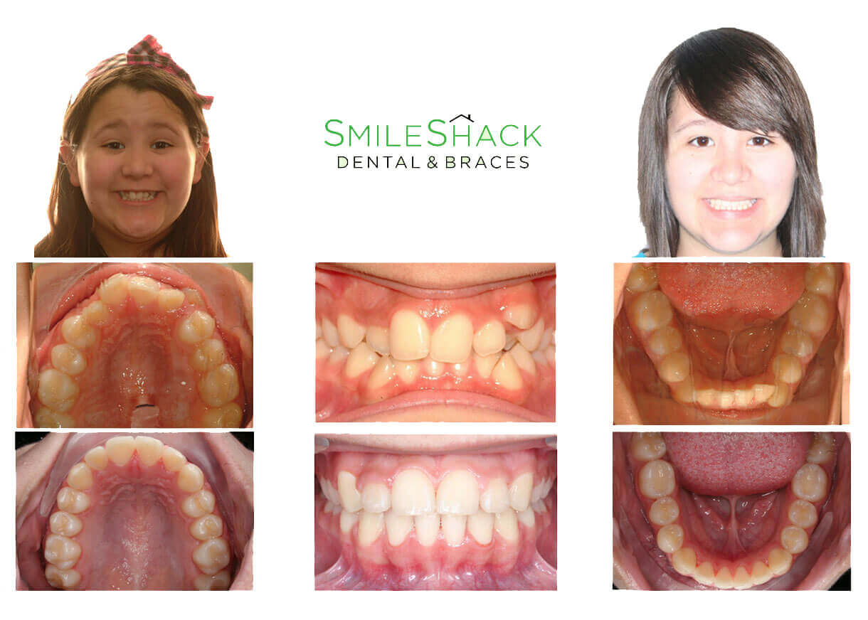 before and after cosmetic smile makeover