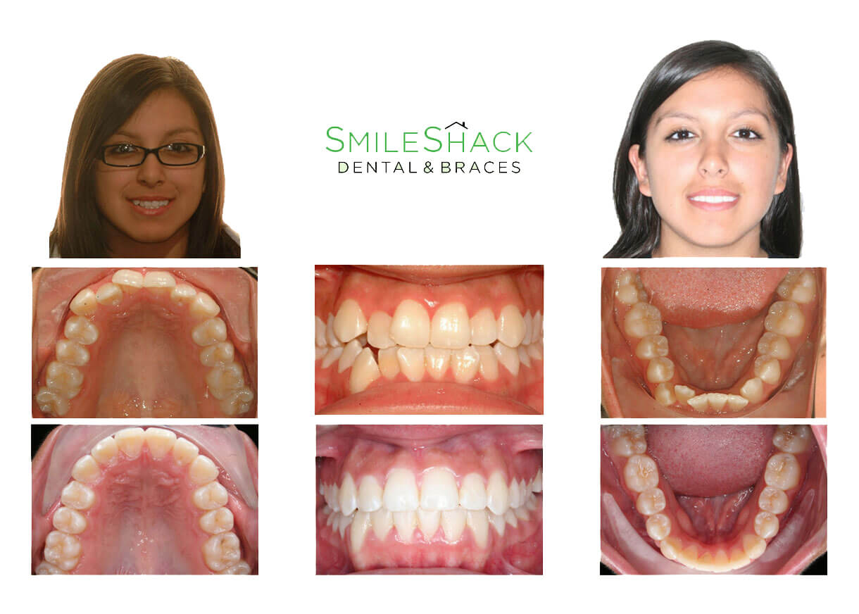 before and after cosmetic smile makeover