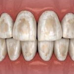 oral hygiene with braces, demineralization