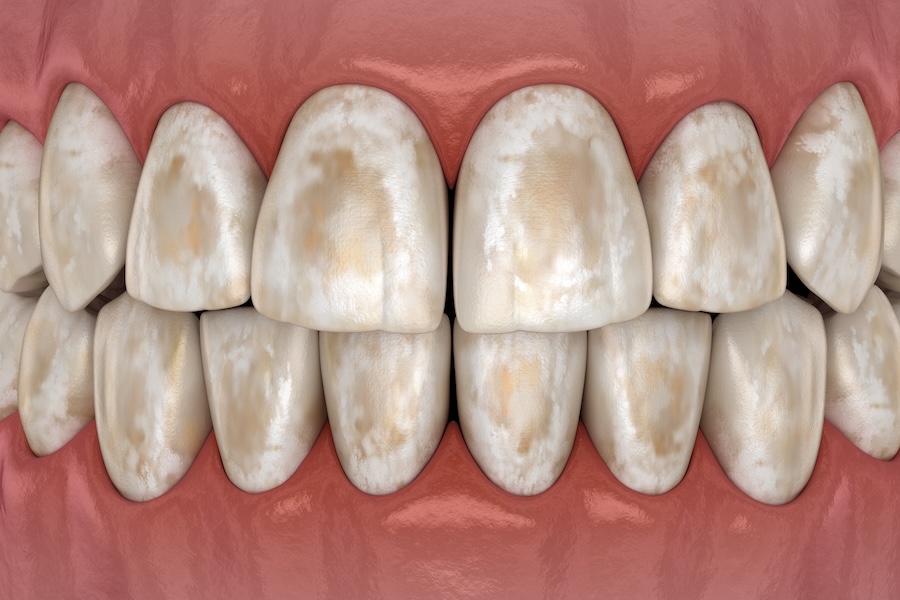 oral hygiene with braces, demineralization