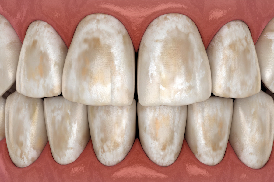 oral hygiene with braces, demineralization