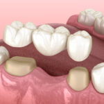 dental bridge, dental bridges, dental crown, dental crowns, bridge vs crown, dental bridge vs dental crown