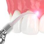 laser gum therapy, periodontal disease treatment, Raytown MO dentist, SmileShack Dental and Braces, gum disease, soft-tissue laser therapy, dental care, gum disease treatment